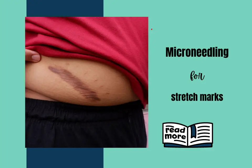 Microneedling for stretch scars